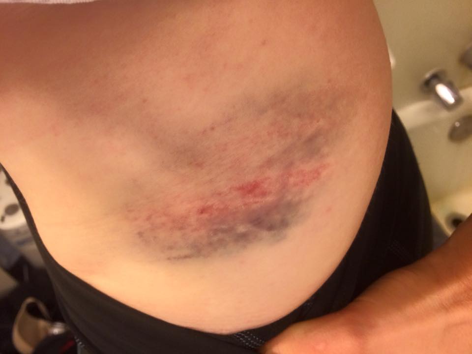 The bruised up hip bone